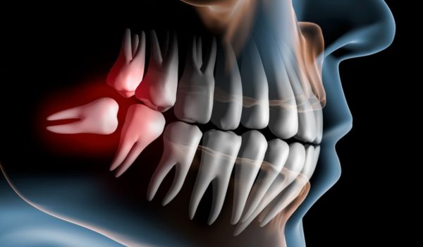 Remoção de dentes em recife